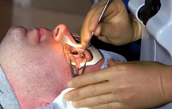 Skleroplastika lühinägelikkuse korral nägemise stabiliseerimiseks